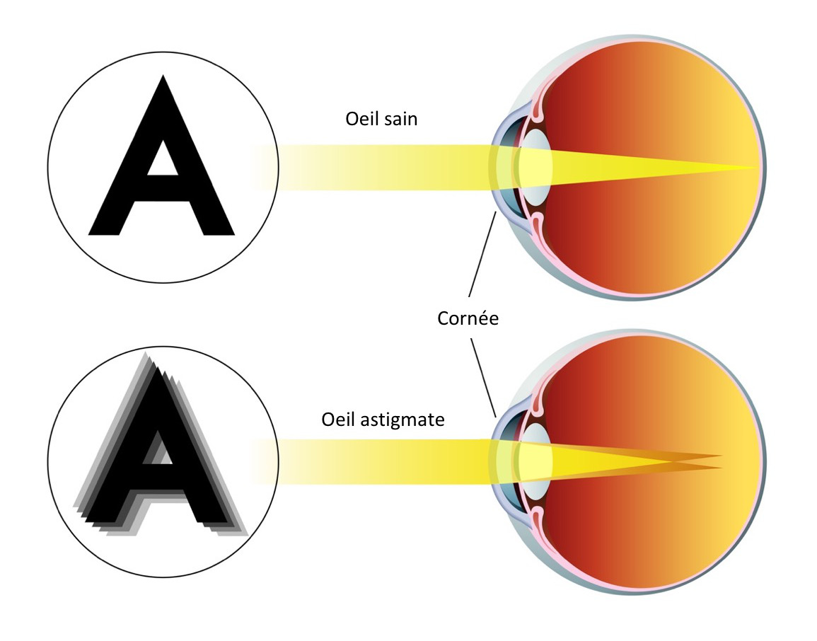 Astigmatisme2