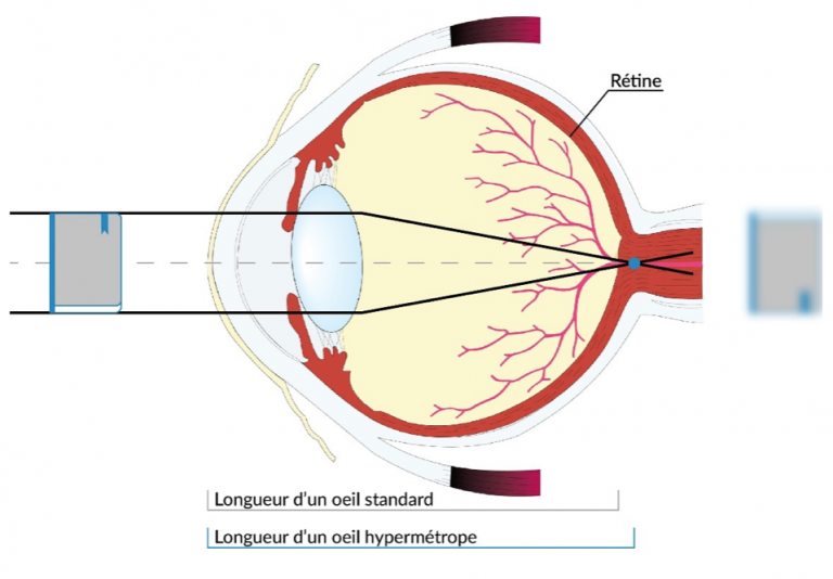 hypermetropie-768x534
